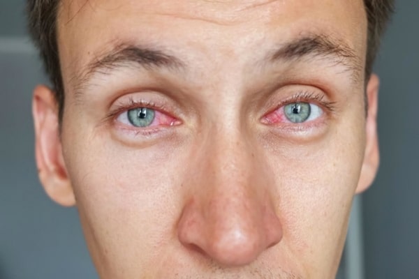 primavera e alergias oculares