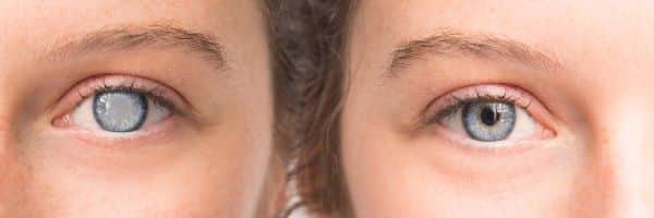 Mitos e verdades sobre a catarata - olhos antes e depois da cirurgia 