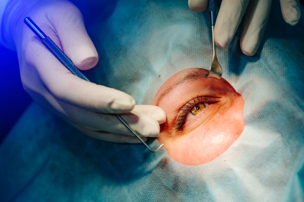 Avanços Tecnológicos na Cirurgia Minimamente Invasiva para Glaucoma