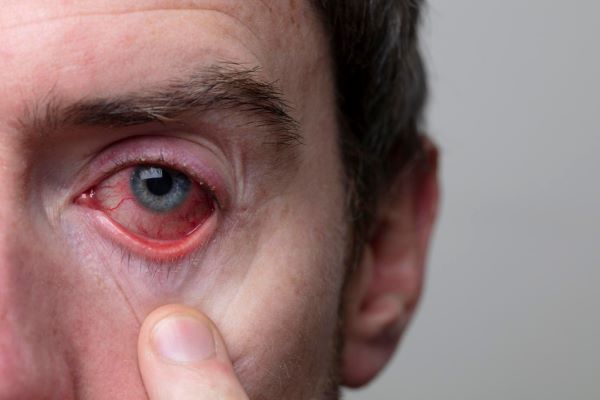 Homem com os olhos vermelhos - sintoma grave de conjuntivite.